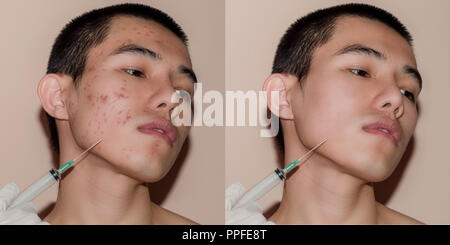 Acne problem. Young man before and after treatment on white background ...