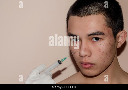Acne problem. Young man before and after treatment on white background ...