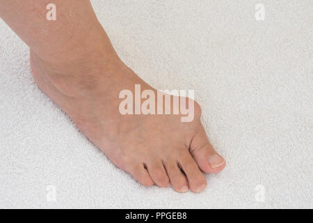 bunion on joint of big toe, close-up of foot Stock Photo