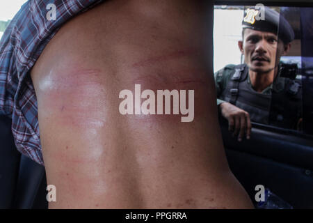 Lhokseumawe, Aceh, Indonesia. 25th Sep, 2018. A convicted person seen with wounds after being sentenced to whips for violating the Islamic Sharia law.Although considered to violate the International Convention against Cruel, Inhuman or Torture and Cruelty. Aceh, one of the provinces in Indonesia that insists on carrying out whipping as a province of Islamic Sharia law. Credit: Maskur Has/SOPA Images/ZUMA Wire/Alamy Live News Stock Photo