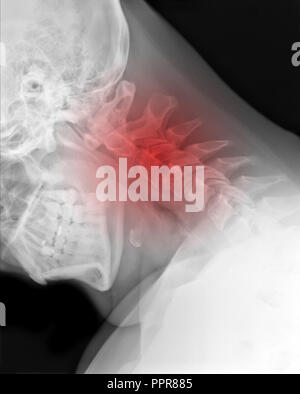 X-ray picture - Cervical spine with red symbol of painful place Stock Photo