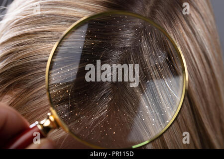 Close-up Of A Dandruff In Blonde Hair Seen Through Magnifying Glass Stock Photo