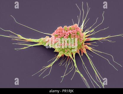 Dendritic cell. Coloured scanning electron micrograph (SEM) of a protective cell of the human immune system known as a dendritic cell. The long projections seen on the cell's surface are 'feet' to help it move. These cells process foreign antigens which then act like an alarm signal, alerting other immune cells of the body to the infection. Dendritic cells found in the upper layer of the skin (the epidermis) are known as histiocytes or Langerhans cells. In the central nervous system they are known as microglia, and in the liver as Kupffer cells. Magnification:x 3000 when printed at 10cm wide. Stock Photo