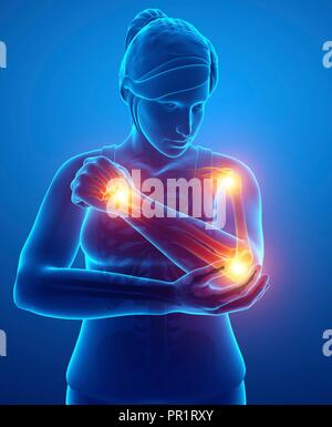 Woman with arm pain, computer illustration. Stock Photo