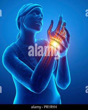 Woman with wrist pain, computer illustration. Stock Photo