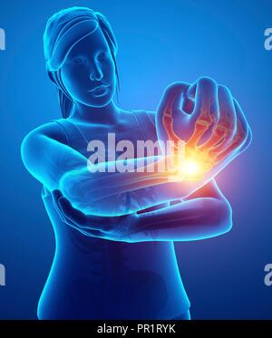 Woman with elbow pain, computer illustration. Stock Photo