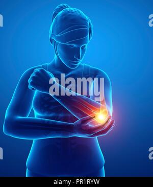 Woman with elbow pain, computer illustration. Stock Photo