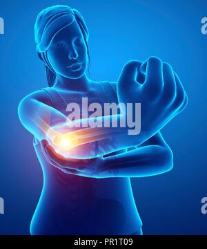 Woman with elbow pain, computer illustration. Stock Photo