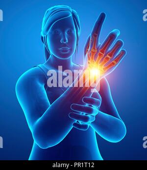 Woman with wrist pain, computer illustration. Stock Photo