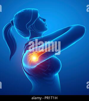 Woman with shoulder pain, computer illustration. Stock Photo