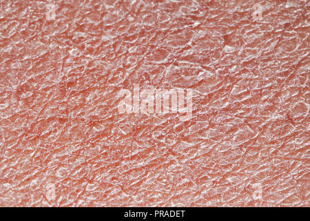 background texture of unhealthy human skin covered with deep wrinkles and dry flaky particles Stock Photo