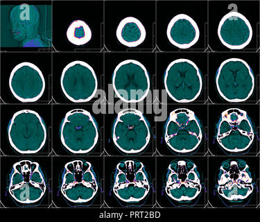 Head in computer tomography, color CT image Stock Photo