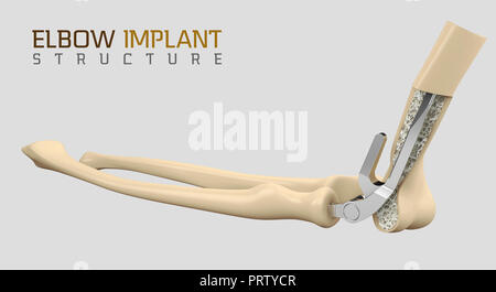 3d illustration of the endoprosthesis of the elbow joint Stock Photo