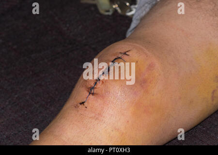 Male knee after surgical operation, knee replacement. Knee surgery in the hospital Stock Photo