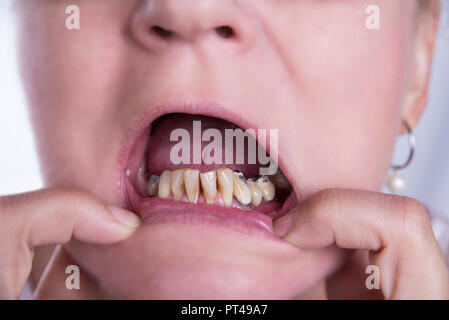 Woman with bad teeth and tartar from smoking and old crowns Stock Photo ...