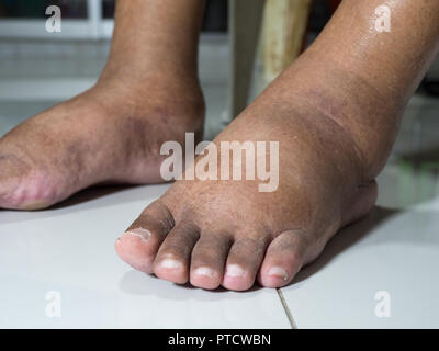 The feet of people with diabetes, dull and swollen. Due to the toxicity of diabetes placed on a white background. Stock Photo