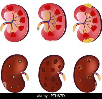 3D Realistic anatomy vector set kidney, normal kidney, kidney infection, sick kidney. Anatomy human. Medicine concept, vector illustration isolated on white background Stock Vector