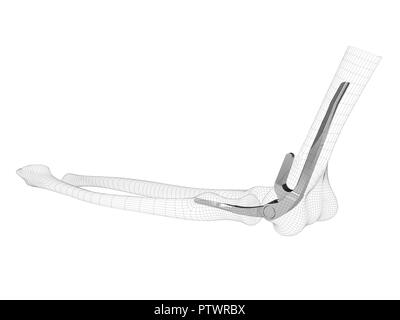 3d illustration of the endoprosthesis of the elbow joint. Stock Photo