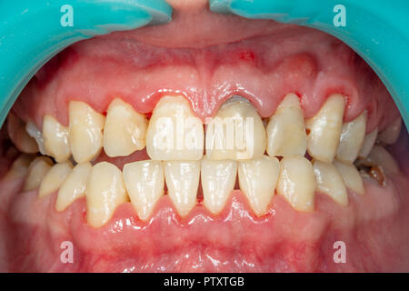 Plaque of the patient, stone. Dentistry treatment of dental plaque, professional oral hygiene. The concept of harm to smoking and cleaning teeth Stock Photo