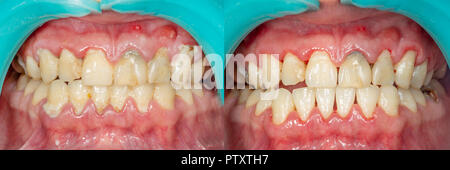 Plaque of the patient, stone. Dentistry treatment of dental plaque, professional oral hygiene. The concept of harm to smoking and cleaning teeth Stock Photo