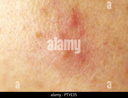 Redness from acne on the skin, cheek, macro, white-head Stock Photo