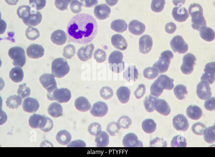 Blood under a microscope. Lymphocyte Stock Photo