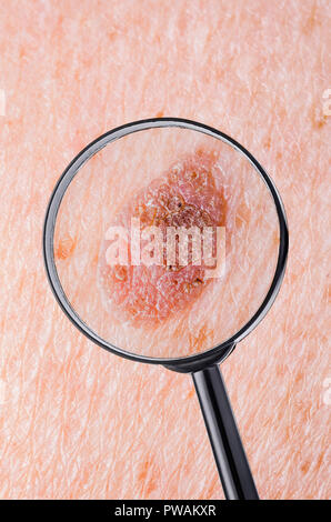 Skin Mole Defect High Magnification Macro Photo for Medical Diagnosis Stock Photo