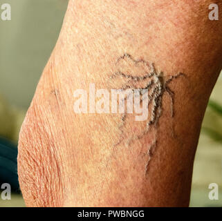 Close up varicose spider vein on skin crook leg elderly woman, Problem ...