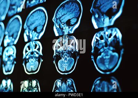 Magnetic resonance image scan of the brain. MRI film of a human skull and brain. Neurology background. Medicine, science, side view Stock Photo