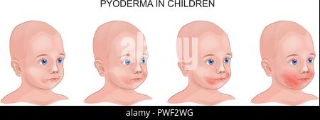 Strept Pyoderma vector illustration in child pyoderma. Streptococcus, Staphylococcus ...
