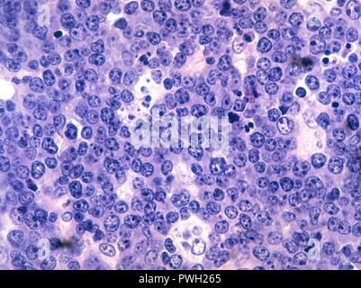 Burkitt's lymphoma Histopathology. Stock Photo