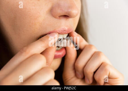 young woman puts transparent aligner for dental treatment Stock Photo