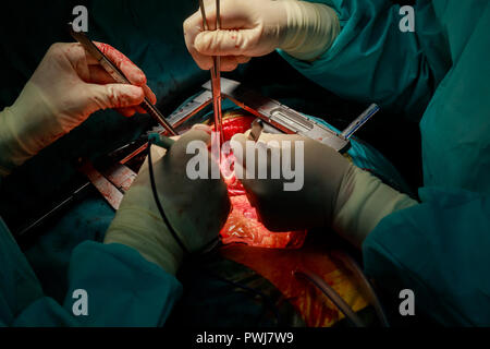 Suture of an lung emphysema surgery in an infant, medical assistance close-up Stock Photo