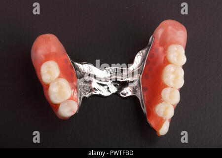 Clasp prosthesis with lock fixation isolated on white background macro. Stock Photo