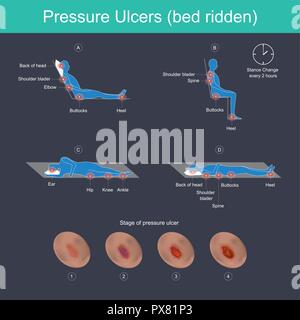 Pressure ulcers are injuries to the skin, primarily caused by prolonged pressure on the skin. They can happen to anyone, but usually affect people con Stock Vector