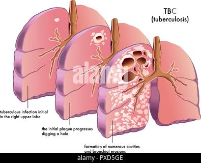 TUBERCULOSIS, DRAWING Stock Photo: 49248067 - Alamy