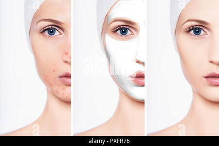 female face with acne and without acne, after using a facial mask Stock Photo