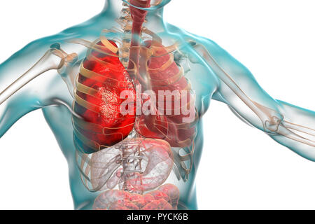 Pneumonia, illustration. Pneumonia is an inflammatory condition of the lung. Stock Photo