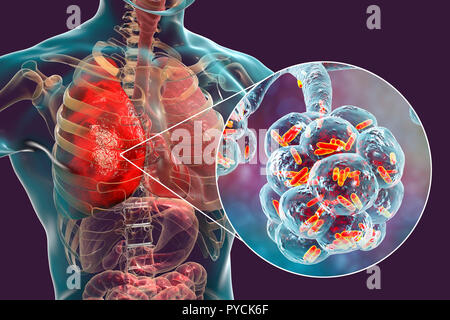 Bacterial pneumonia. Computer illustration of rod-shaped bacteria (bacilli) inside the alveoli of the lungs, causing a lower respiratory tract infection. This is more generally known as pneumonia, though that term can also be reserved for specific types of infection. Severe lung infections are diagnosed by X-ray and treated by antibiotics. The alveoli are the site of gaseous exchange between the air in the lungs and the blood. Stock Photo