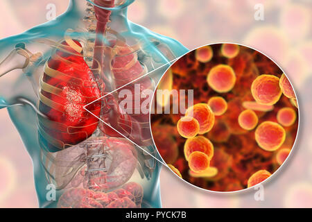 Pneumonia caused by Mycoplasma pneumoniae bacteria, conceptual computer illustration. Mycoplasmas are the smallest cellular organisms known (diameter Stock Photo