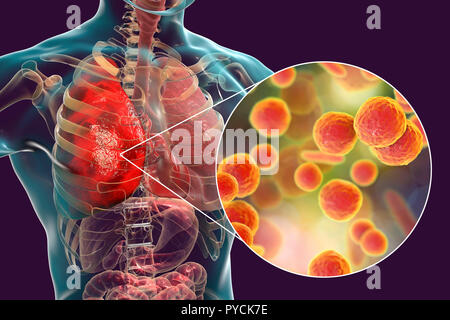 Pneumonia caused by Mycoplasma pneumoniae bacteria, conceptual computer illustration. Mycoplasmas are the smallest cellular organisms known (diameter Stock Photo