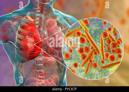 Pneumonia caused by Mycoplasma pneumoniae bacteria, conceptual computer illustration. Mycoplasmas are the smallest cellular organisms known (diameter Stock Photo