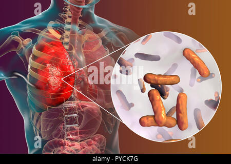 Pseudomonas aeruginosa bacteria, computer illustration. P. aeruginosa ...