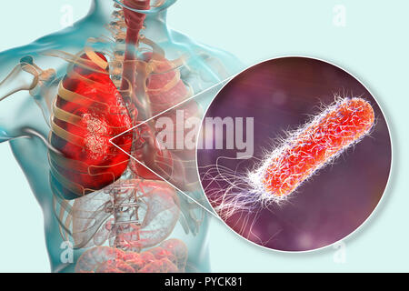 Pneumonia caused by bacteria Pseudomonas aeruginosa, computer illustration. P. aeruginosa is a Gram-negative bacterium which causes multiple antibiotic resistant nosocomial (hospital-acquired) infections of different location, including pneumonia, osteomyelitis, peritonitis and wound infections. Stock Photo