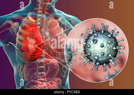 Pneumonia caused by varicella zoster virus (VZV), computer illustration. VZV is a virus from the Herpesviridae family, the causative agent of chickenpox and shingles. In severe cases VZV may cause complications, such as pneumonia and encephalitis. Stock Photo