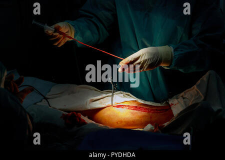 A surgeon performs vein separation for Coronary Artery Bypass Grafting operation in the operating room Stock Photo