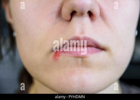 Herpes on young woman lips. Close up Stock Photo