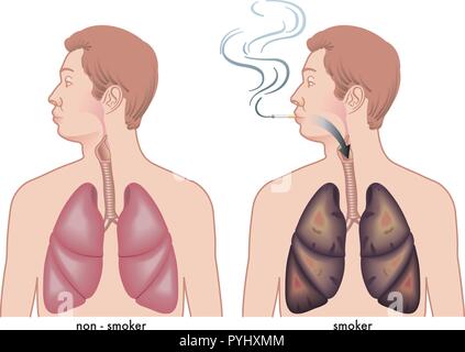 medical illustration of the effects of cigarette smoking on the lungs Stock Vector