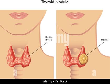 medical illustration of the symptoms of thyroid nodule Stock Vector