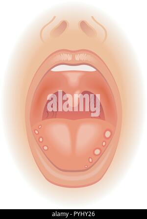medical illustration of symptoms of tongue sores Stock Vector